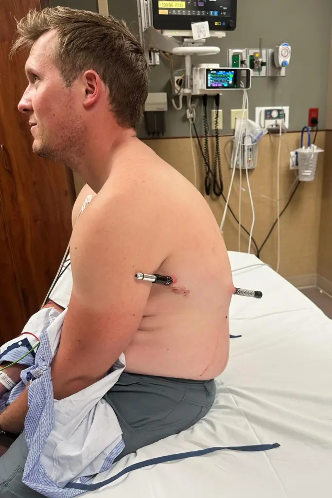 David Cifaldi while he was being treated with a trekking pole in his body.