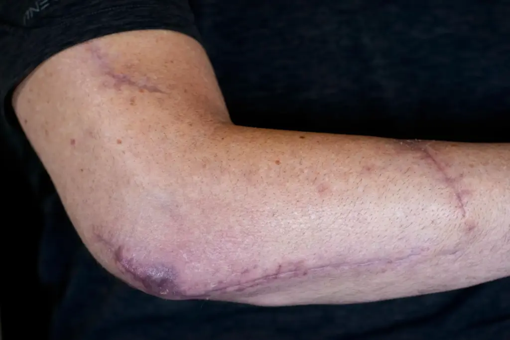 Lt. Col. Tim Halbur, who was injured in an Iranian...